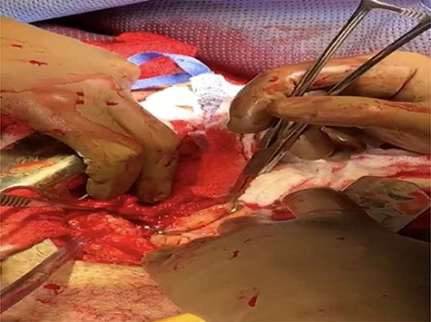 A Satinsky’s clamp is being applied over the atrial injury