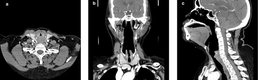 Computerized tomography images of the neck showing stenosis, worst at the subglottic level; (a) axial plane; (b) coronal plane; (c) sagittal plane.