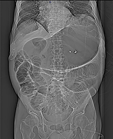 Plain abdomen radiography shows distended stomach and dilatated loops of bowel without free gas in the peritoneal cavity.