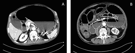 Axial CT scans of abdomen show gastrectasia with the NG tube just inserted (A) and a suspected image of bowel emphysematous walls (B).