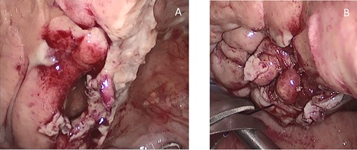 Intraoperative findings of the bladder diverticulum, before (A) and after (B) suture.