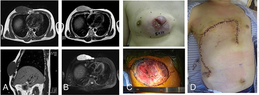 42-year-old male with dermatofibrosarcoma protuberans in the chest wall. Magnetic resonance imaging shows the subcutaneous tumor with low-signal intensity on the T1-weighted image (A) and slightly high-signal intensity on the T2-weighted image (B-upper) and high-signal intensity on a T2-weighted fat-suppressed image (B-lower); photograph of ulcerated subcutaneous lesion with subcutaneous extension; after resection of the tumor with the surrounding tissue (C), the defect was reconstructed with a thoracoabdominal flap (D).