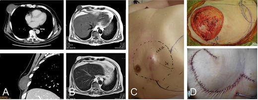 76-year-old male with recurrent myxofibrosarcoma. Computed tomography revealed the initial 6-cm subcutaneous lesion of the patient at 73 years of age (A); 3 years after resection of the initial lesion, T1- and T2-weighted images show a 3-cm recurrent lesion with high-signal intensities (B-upper) and (B-lower), respectively. Photograph showing protuberant subcutaneous lesion (C); defect after resection of the tumor with the surrounding tissue (D-upper). The defect was reconstructed with a thoracoabdominal flap (D-lower).