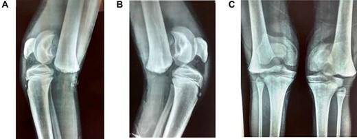 (A) Lateral view of right knee at presentation, (B) lateral view of left knee at presentation, (C) frontal view of both knees at presentation