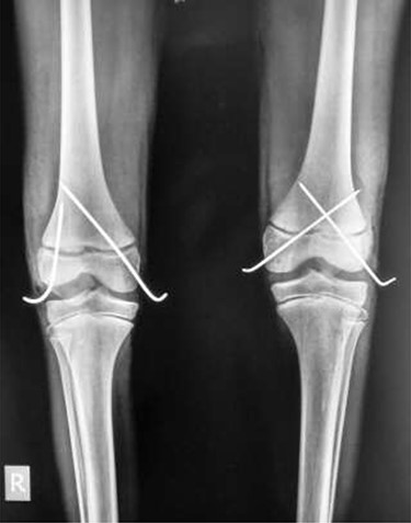 Frontal view of both knees after closed reduction and K-wire fixation
