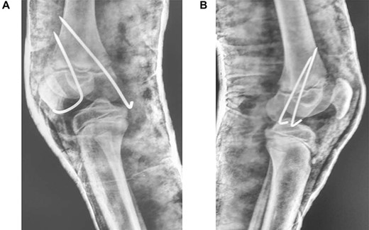 (A) Lateral view of right knee after closed reduction, K-wire fixation and anterior slab application; (B) Lateral view of left knee after closed reduction, K-wire fixation and anterior slab application