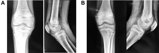 (A) Frontal and lateral view of right knee at 6-months post-injury; (B) frontal and lateral view of left knee at 6-months post-injury