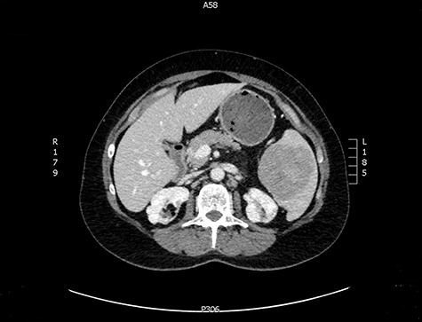 CT image of a splenic mass
