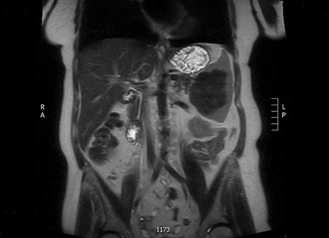 MRI image of a splenic mass