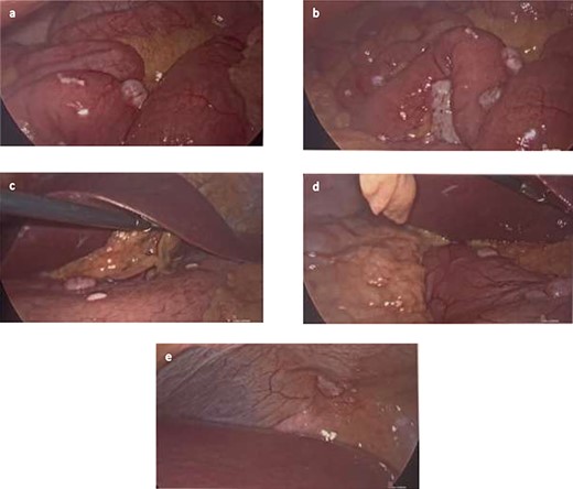 (a and b) Nodules found on small bowel mesentery. (c and d) Nodules on the stomach. (e) Nodule on the peritoneal cavity.