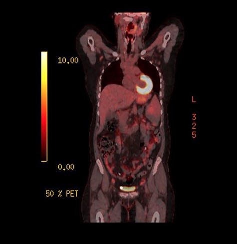 PET scan showing low-grade activity in the spleen