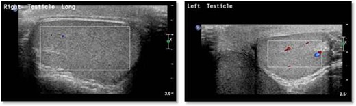 Scrotal Doppler ultrasound shows the size, echogenicity and vascularity is maintained for both testicle with slightly reduced in the right testicle that could be suggestive of right torsion/detorsion.