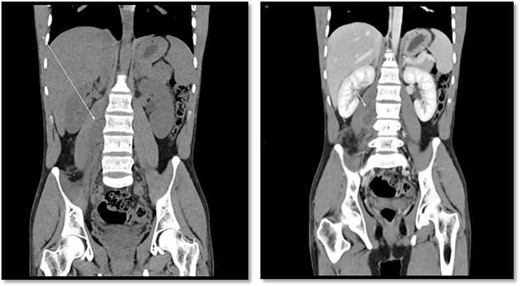 CT scan showed there is 4 × 3 cm lobulated mass noted at the right paravertebral space invading the right psoas muscle at the level of L3 and L4 and extending through the neural foramina, the associated with epidural component compressing the spinal cord from the level of the L2–L4.