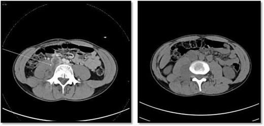 On the left image, there is associated fistulas tract between the mass and infrarenal inferior vena cava with a small hyperdense component may represent hemorrhage or solid component. The right image CT scan showed the mass extending through the neural foramina compressing the spinal cord from the level of the L2–L4.