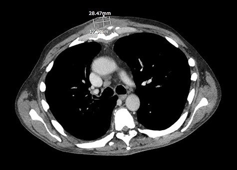 CT scan of the chest revealed a 1.8 × 2.8 × 3.6 cm fluid at right subpectoral space and sterno-manubrial joint.