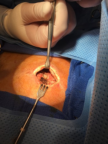 Incision, drainage and debridement of the right subpectoral space and sterno-manubrial joint abscess.
