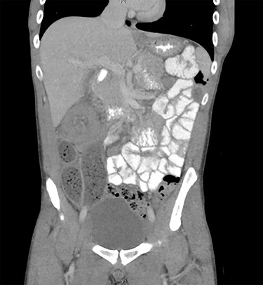 CT of the abdomen and pelvis with coronal view showing ileo-colic intussusception.