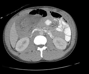 CT of the abdomen and pelvis with axial view showing ileo-colic intussusception.