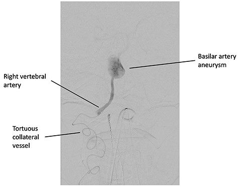 Digital subtraction angiography, demonstrating the catheter in the tortuous collateral vessel from the right thyrocervical artery supplying the right vertebral artery.