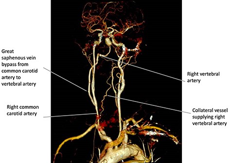 Three-dimensional reconstruction of the contrast enhanced computed tomography scan performed on Day 1 post CCVAB, demonstrating a patent bypass and flow through the right vertebral artery and to the aneurysm.