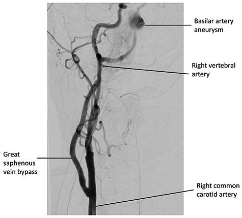 Digital subtraction angiography from the right common carotid artery, demonstrating the CCVAB and decreased filling of the basilar artery after a successful delivery of the pipeline flow diverting stent.