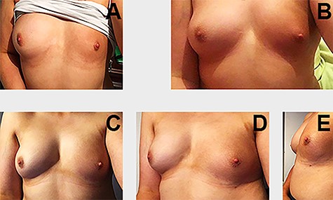 (A) Before the first procedure; (B) Result after the one session of lipofilling; (C–E) Result following two sessions of lipofilling with notable improvement in breast symmetry and pigmentation of the nevus (pictures taken in a mirror).