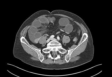 CT scan: severe mechanical obstruction of the small intestine caused probably by adhesions.