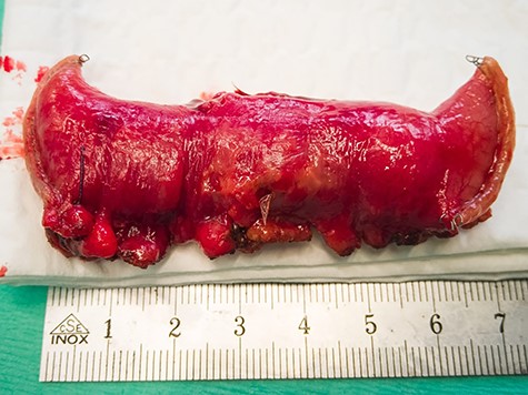 Small bowel resection.