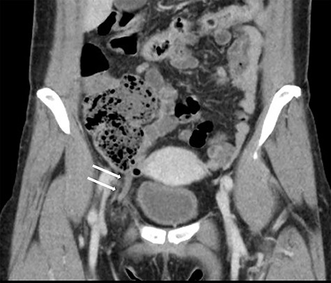 Coronal view in the abdominal CT scan shows the appendix inside the right femoral canal.
