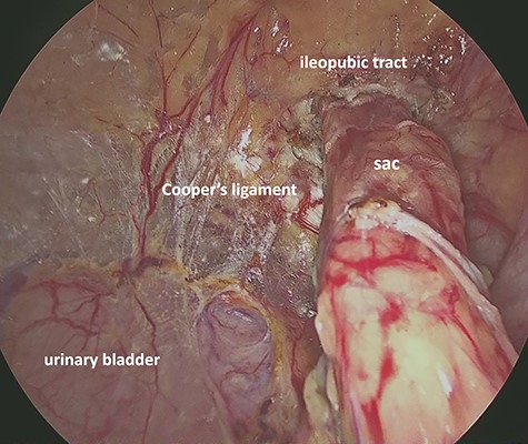 Preperitoneal view of the incarcerated hernia sac into the femoral ring.