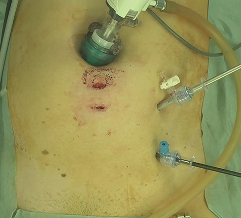 The working trocars are replaced to the left lower abdomen for the intra-abdominal operation.