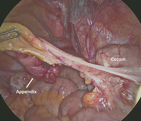Intra-abdominal view shows the inflamed appendix without any symptoms of necrosis, perforation or abscess formation.