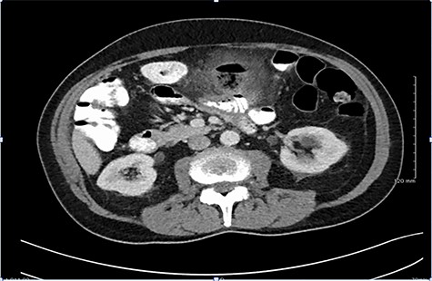 CT findings demonstrating large inflammatory mass related to perforated jejunal diverticulitis.