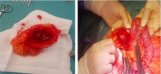 (a, b) Intra-operative findings; inflammatory mass located on mesenteric border, relating to perforated jejunal diverticulitis.