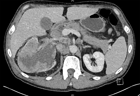 Right renal mass and adrenal/nodal metastasis.