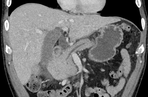 Pancreatic duct dilatation from malignant invasion.