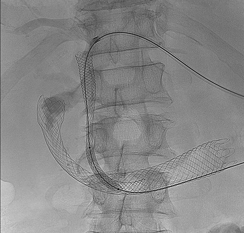 (PTC) Anterograde biliary stent through duodenal wall flex stent.
