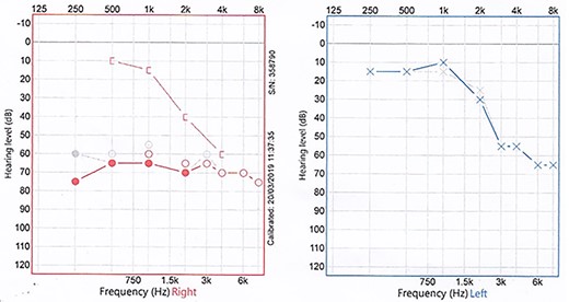 Two superimposed audiograms of the patient, and the interrupted grey line represents the initial one, while the solid coloured line is 5 weeks later; a right mixed hearing loss is noted.