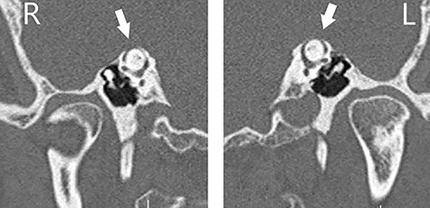 CT scan of the temporal bones of the patient, and images were reformatted in the planes of the right (R) and left (L) SSCs (Pöschl view); bilateral dehiscence (arrows) is noted.