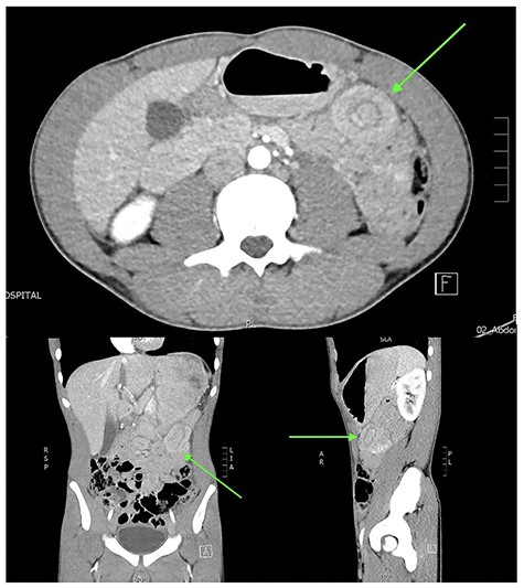 Abdominal CT in axial, coronal and sagittal planes demonstrating mesenteric haematoma and jejuno-jejunal intussusception (‘bowel-within-bowel’ sign indicated by green arrow).
