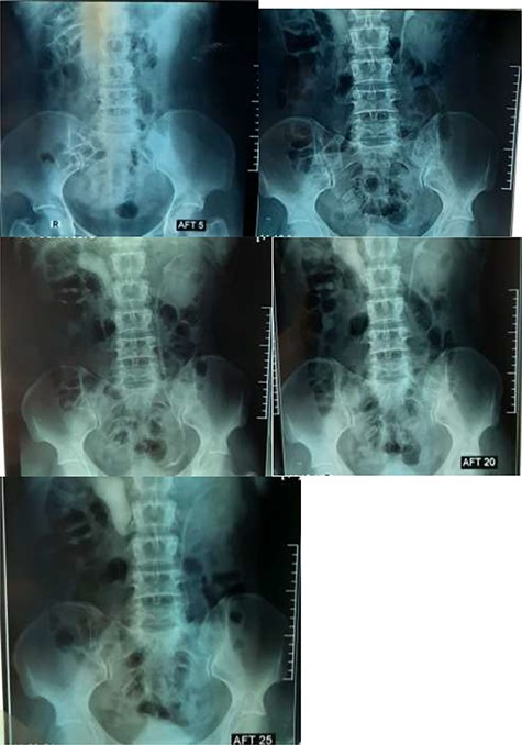 IVU shows S-shaped sign.