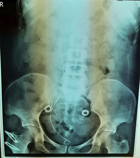 KUB demonstrates right double-j stent.
