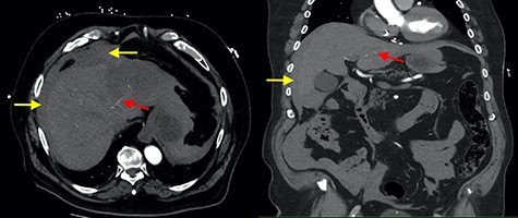 Axial and coronal contrast images of abdomen (yellow arrow—haemoperitoneum, red arrow—contrast extravasation from segment II/III artery).