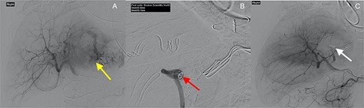 Interventional angiography of the liver (yellow arrow—extravasation of contrast, red arrow—coils placed in segment II/III artery and white arrow—coil in segment II/III artery with no evidence of contrast extravasation).