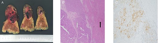 (A) macroscopic specimen demonstrating slices through a haemorrhagic lesion with normal liver parenchyma; (B) images demonstrating liver with intact architecture (black arrow) with HCC (white arrow) and (C) patchy nuclear staining with arginase-1 immunohistochemical stain.