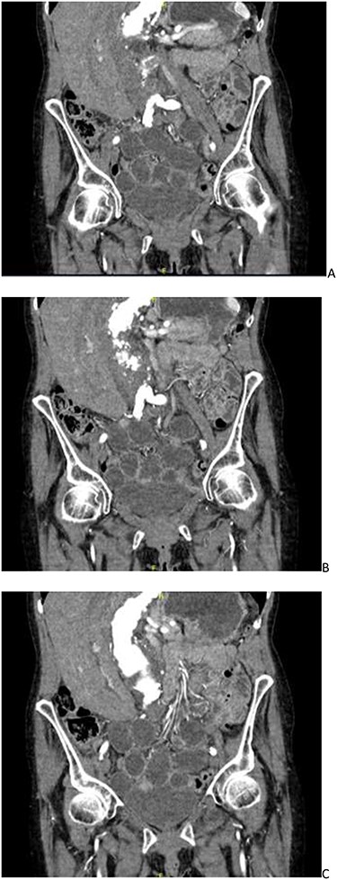CT angiogram showing a left-sided obturator hernia; (A–C) progressing posteriorly in a coronal plane.