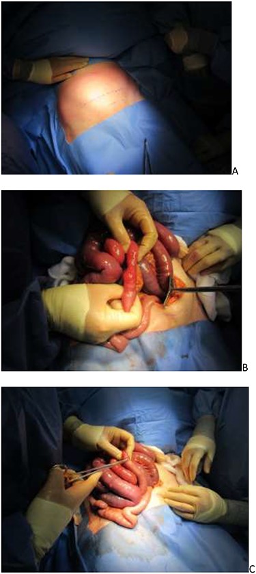 (A) Pfannenstiel incision marked; (B) incarcerated ileum and (C) serosal tear repaired.