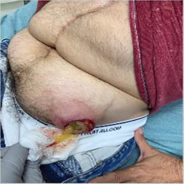 Left lower quadrant mass on physical examination.