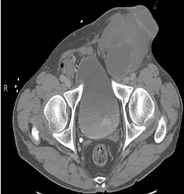 CT imaging abdomen and pelvis with contrast revealed a multiloculated large cystic mass in the left inguinal canal measuring 11 × 7 × 7.7 cm.