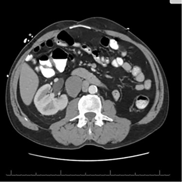 CT scan axial cut evidencing a right retroperitoneal mass measuring 3.3 × 4.2 × 5.7 cm.